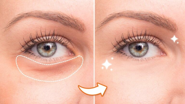 Dark Circle Treatment - Skin Specialist in Karvenagar