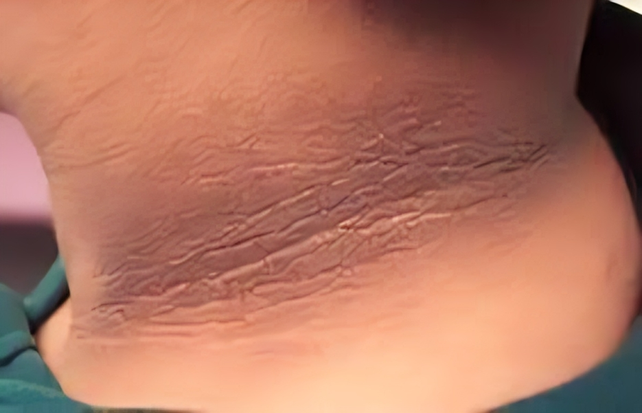 Neck Pigmentation - Dr. Vallari Soman