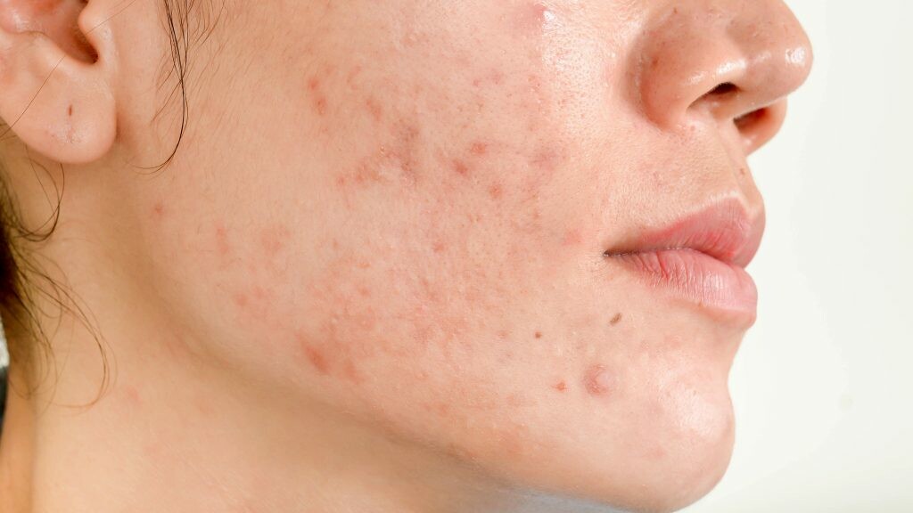 Acne Scars